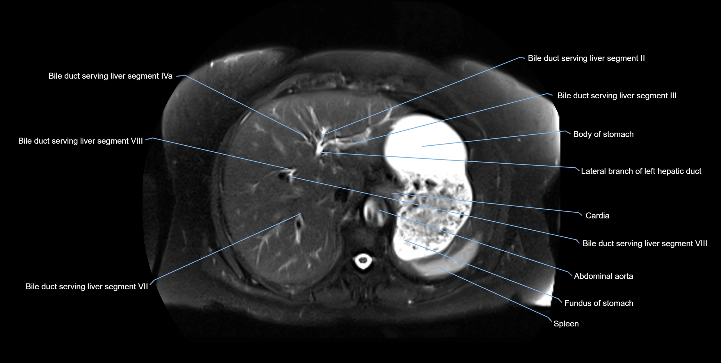 MRI MRCP axial cross sectional anatomy 3T radiology  image-img-10001-00012.webp